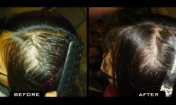 NuHair Transplants Before and After Laser