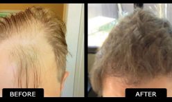 Before and After Hair Transplant Norwood 4